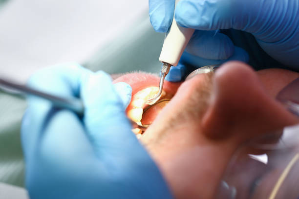 Best Emergency Treatment for Dental Infections or Abscesses in Hobart, WA